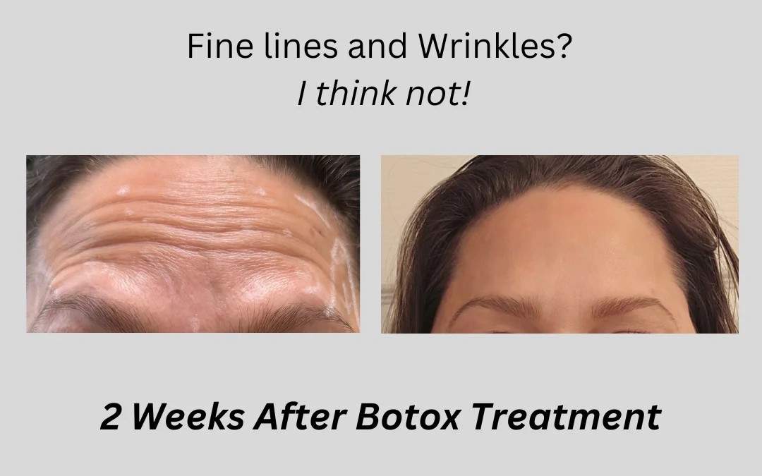 Before and After Botox Treatment in Wading River, NY