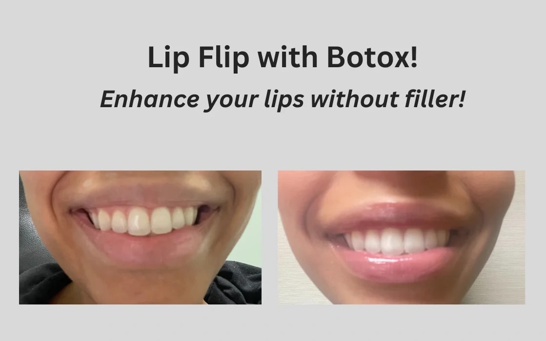 Lip Flip with Botox in Wading River, NY