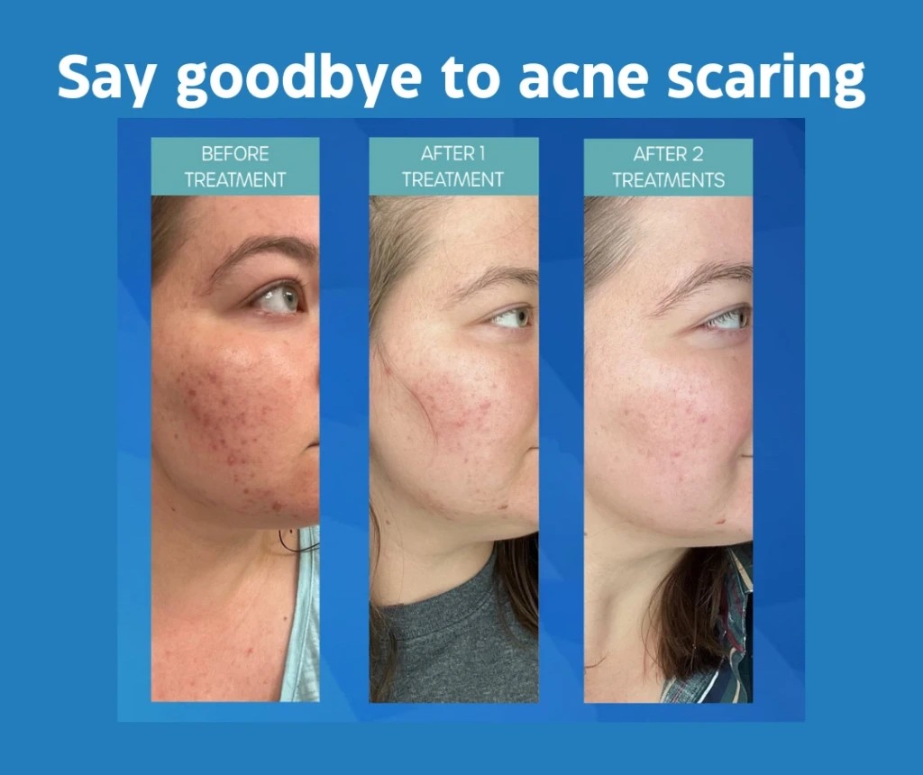 Acne Scars Treatment Wading River NY