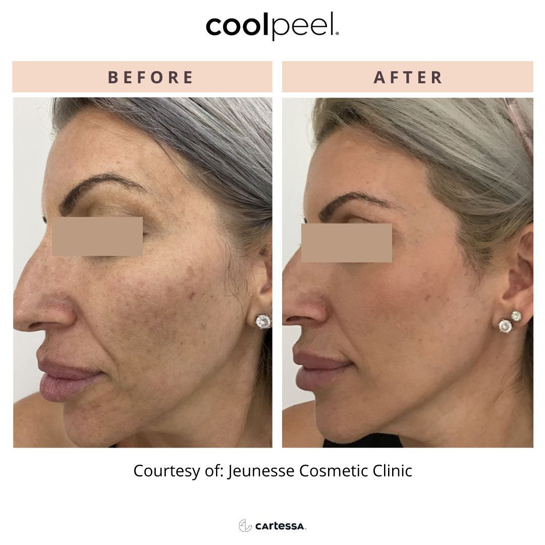 Before and After CoolPeel Treatment in Wading River, NY