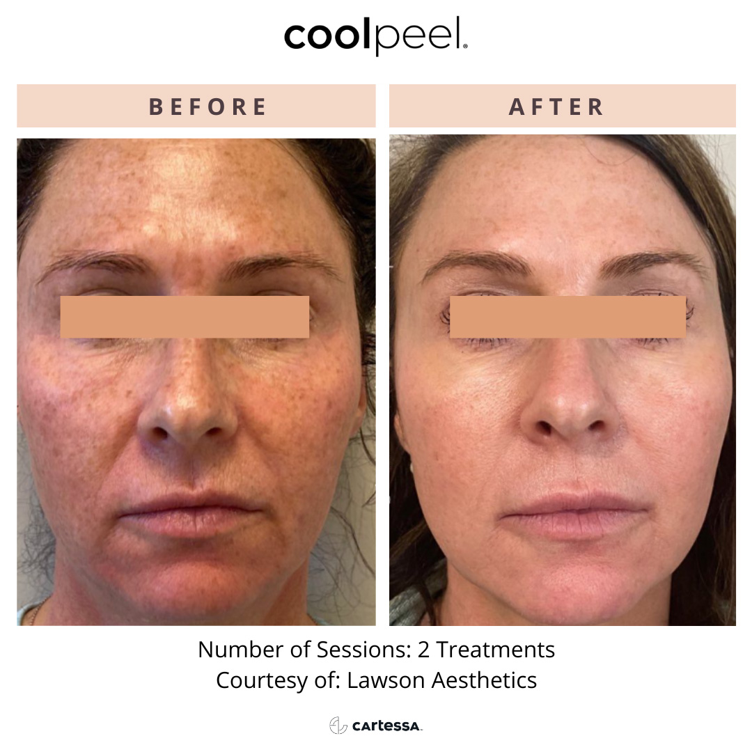 Before and After CoolPeel Treatment in Wading River, NY