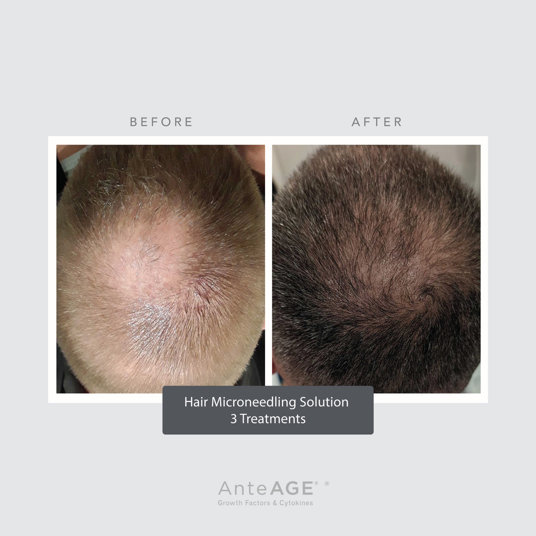 PRP Microneedling Hair Restoration Results in Wading River, NY