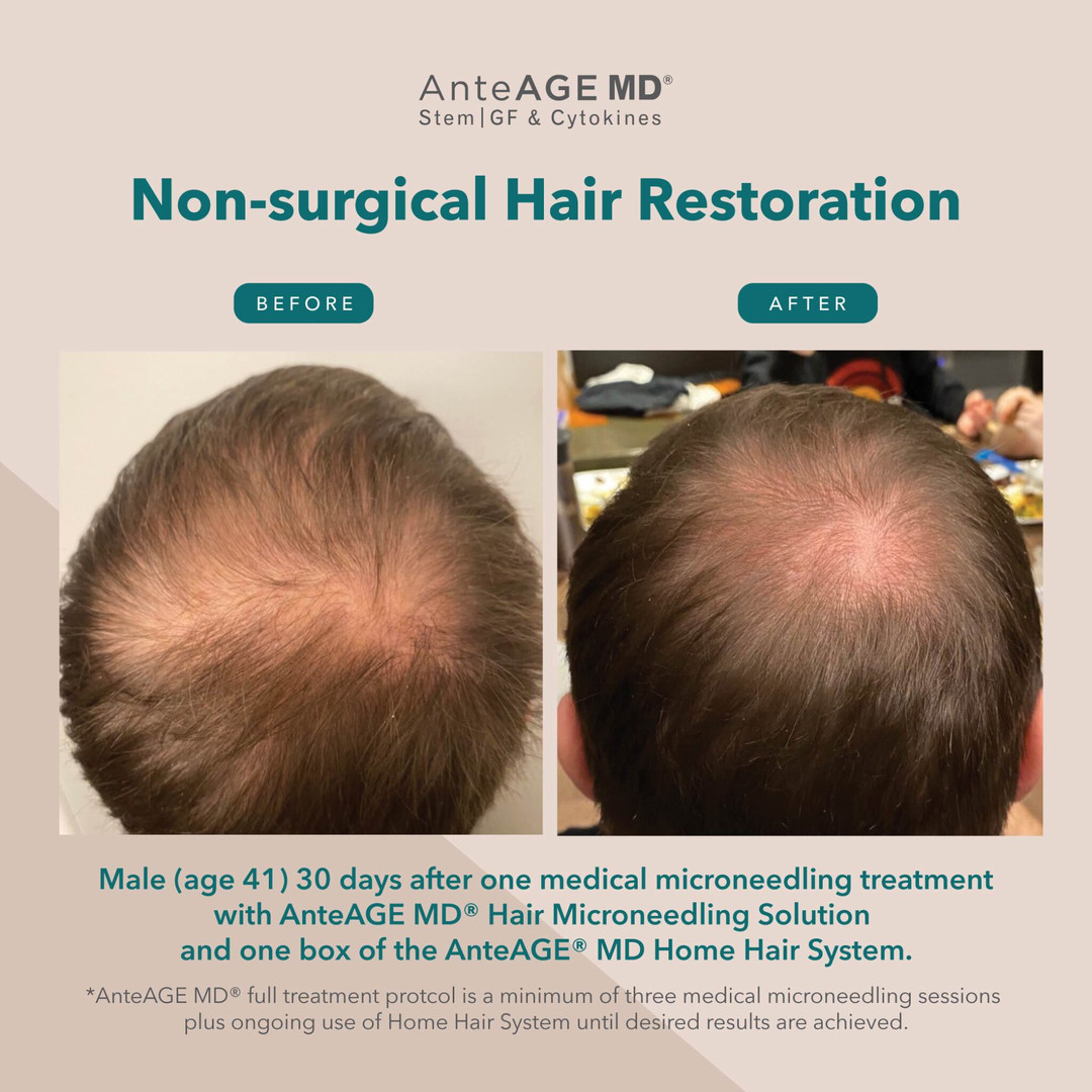 Non Surgical Hair Restoration Treatment in Wading River, NY