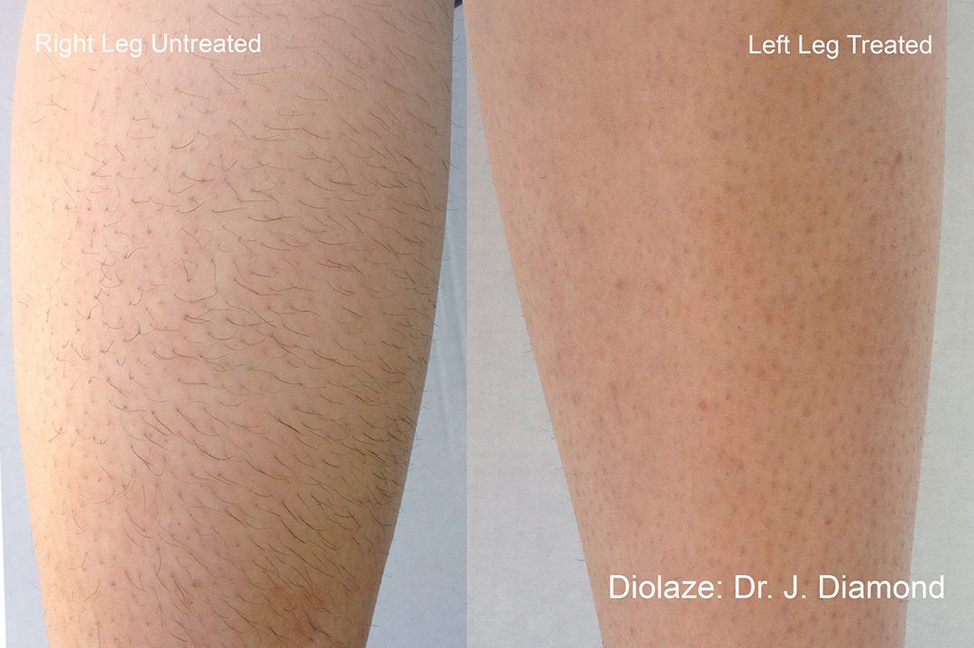 Laser hair remova Results in Wading River, NY