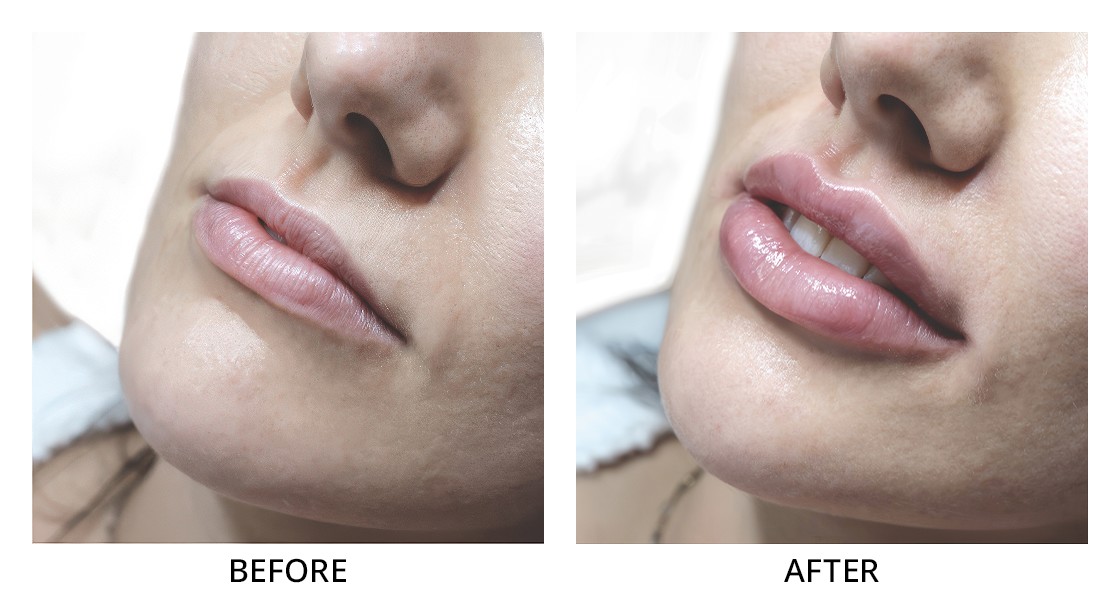 Before and After Lip Filler Treatment in Wading River, NY