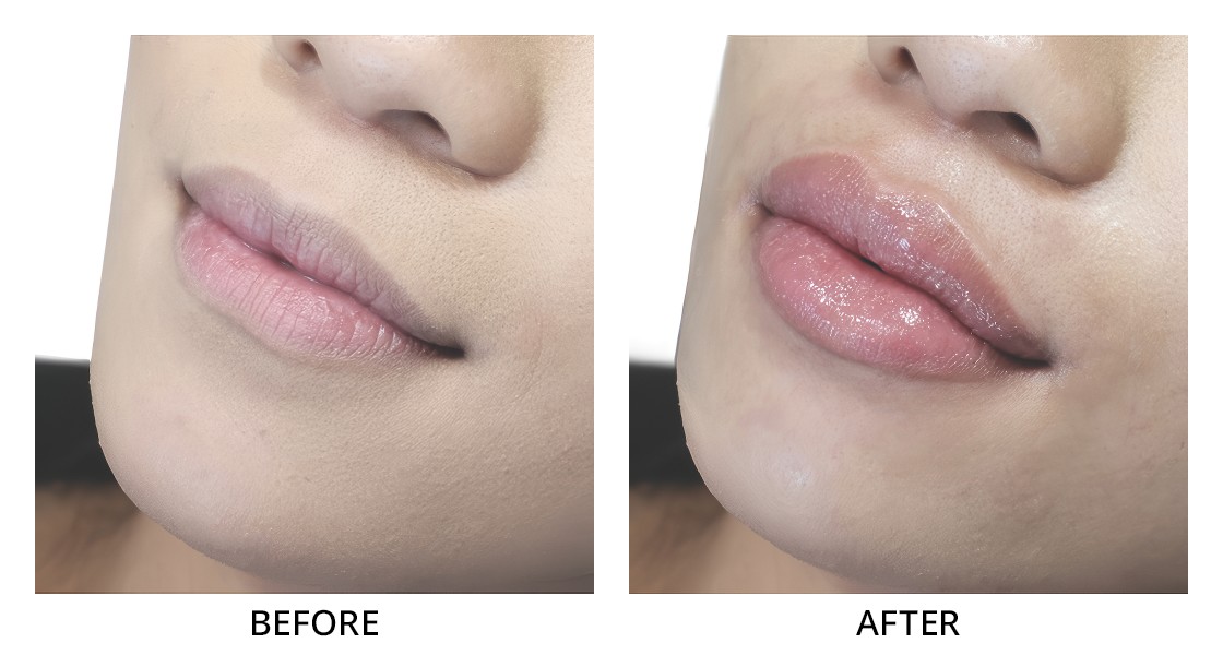 Before and After Lip Filler Treatment in Wading River, NY