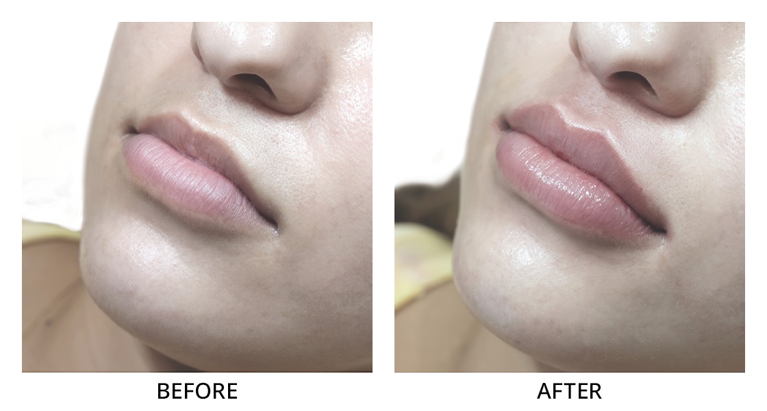 Before and After Lip Filler Treatment in Wading River, NY