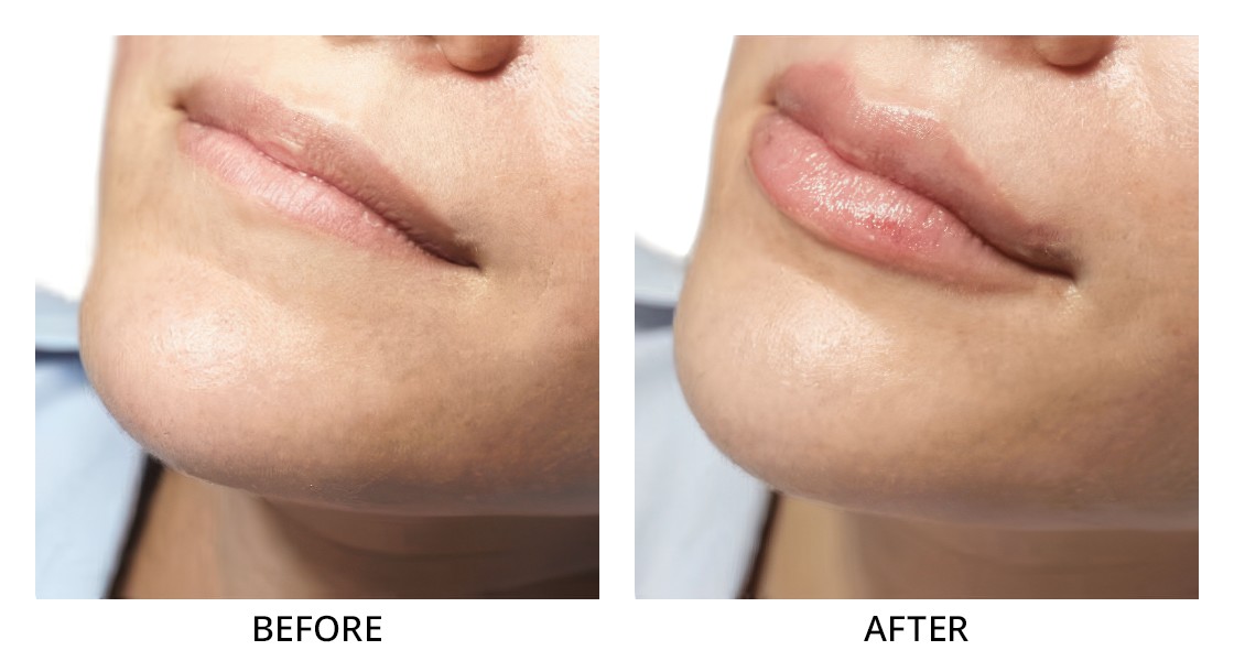 Before and After Lip Filler Treatment in Wading River, NY