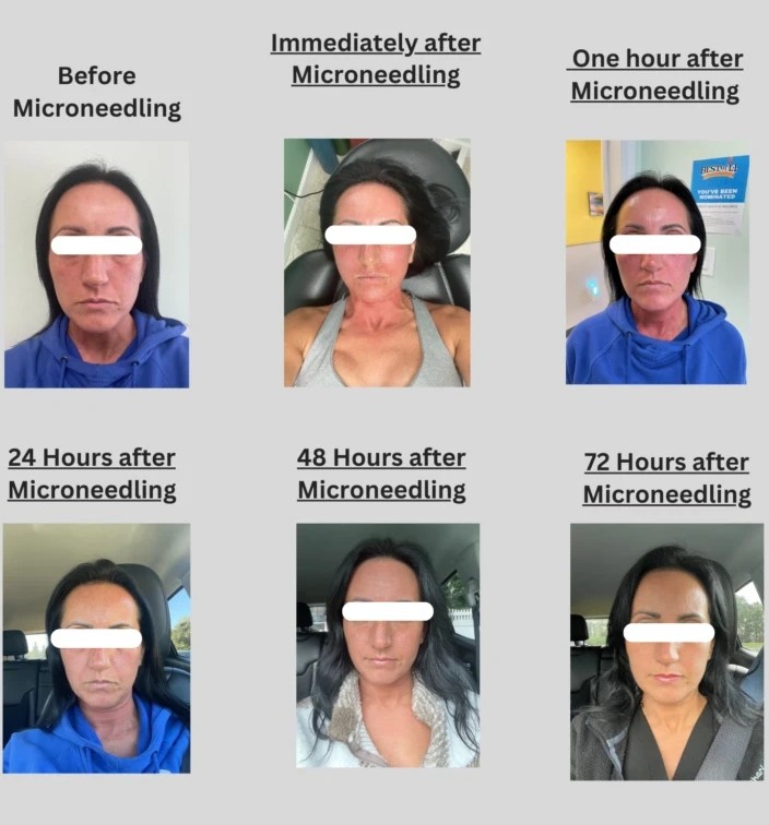 Microneedling Before and After Results