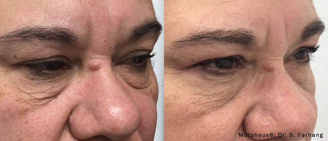 Before and After Morpheus Treatment in Wading River, NY