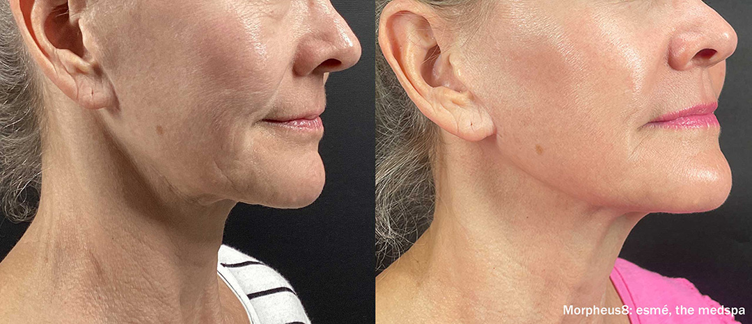 Before and After Morpheus Treatment in Wading River, NY