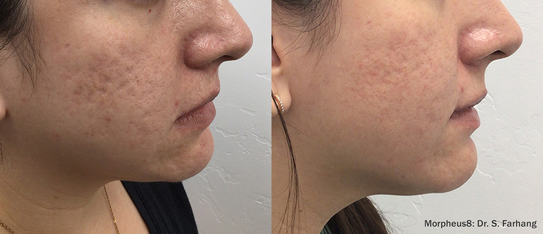 Before and After Morpheus Treatment in Wading River, NY