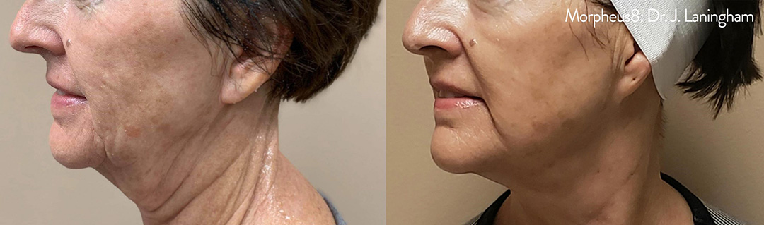 Before and After Morpheus Treatment in Wading River, NY