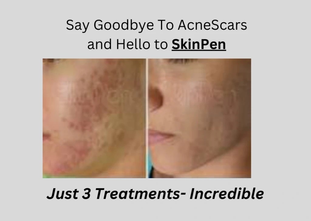 SkinPen Before and After Results